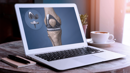 Updated Total Knee Replacement animation now available in HD in the Understand.com® Orthopaedic Library