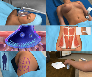 plastic surgery animations now available in Portuguese and Spanish