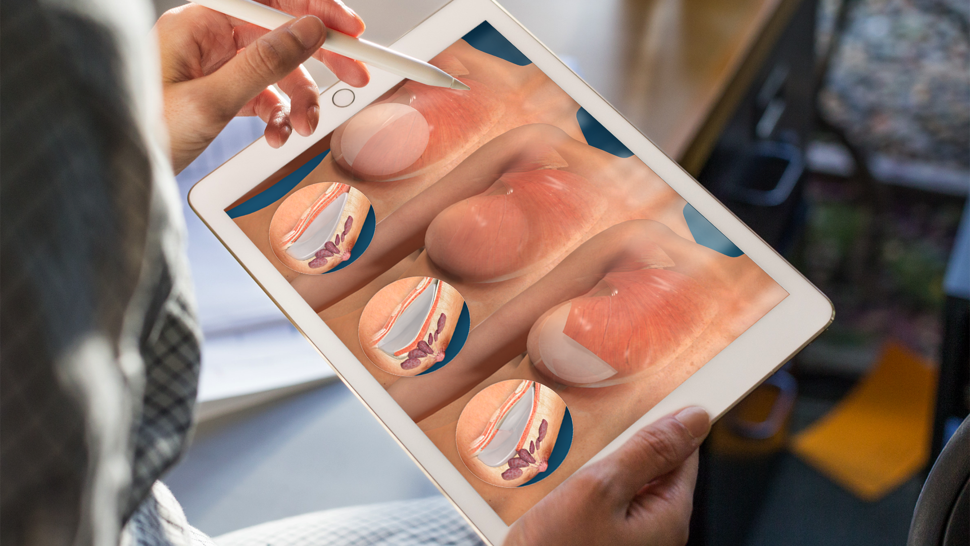 laptop showing a customized Breast Implant Placement