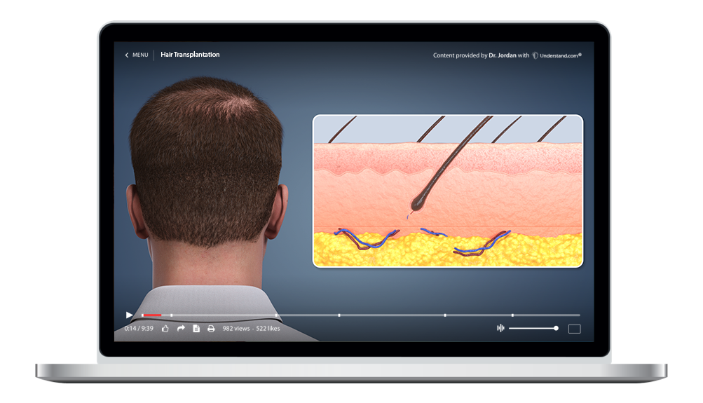 laptop showing a customized Hair Transplantation Animation