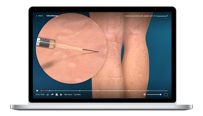 Sclerotherapy Animation