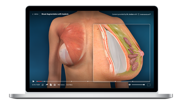 Breast Augmentation with Implants