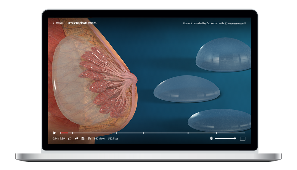 laptop showing a customized Breast Implant Types