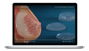 breast-implant-options