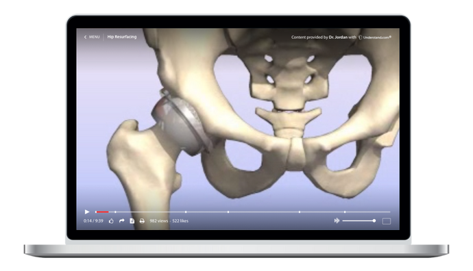 Hip Resurfacing Animation
