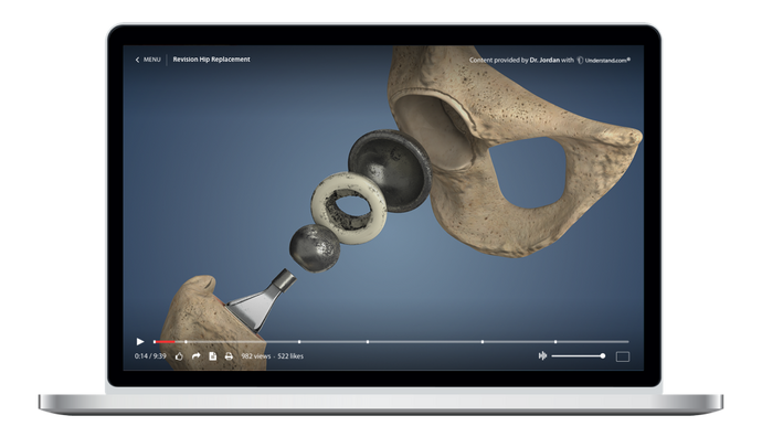 Revision Hip Replacement Animation
