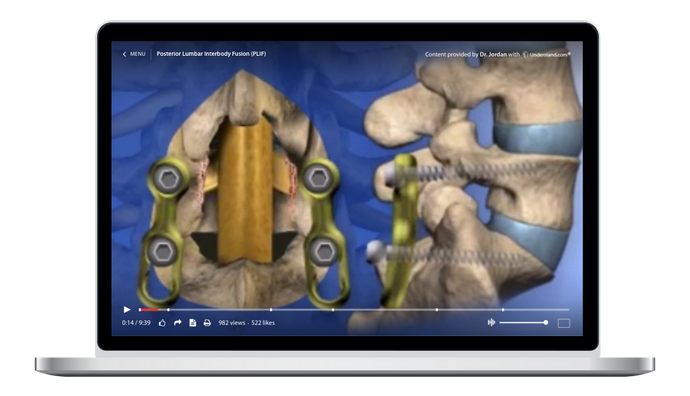 Lumbar - Posterior Lumbar Interbody Fusion (PLIF) Animation