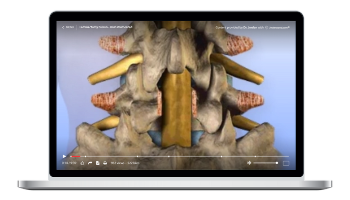 Lumbar - Laminectomy, Fusion - Uninstrumented Animation