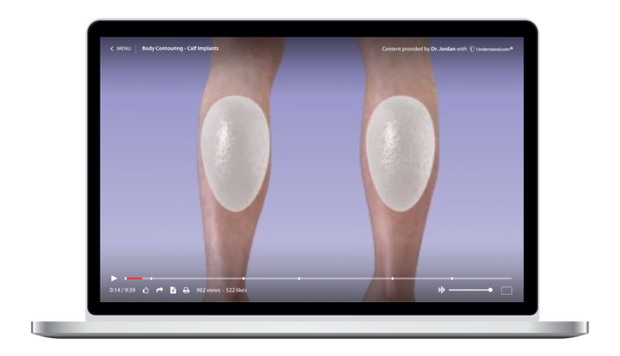 Body Contouring Implants - Calf Animation