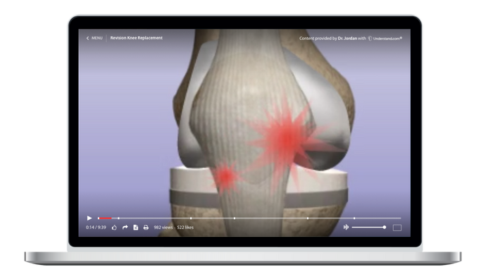 Revision Knee Replacement Animation