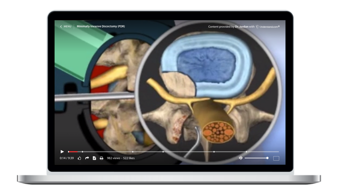 Lumbar - Minimally Invasive Discectomy (PDR) Animation