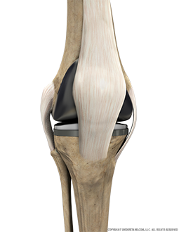 Total Knee Replacement with Ligaments Anterior Extended Image