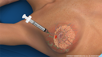Breast Biopsy Image