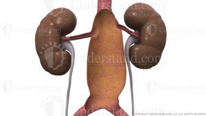 Aortic Aneurysm Image