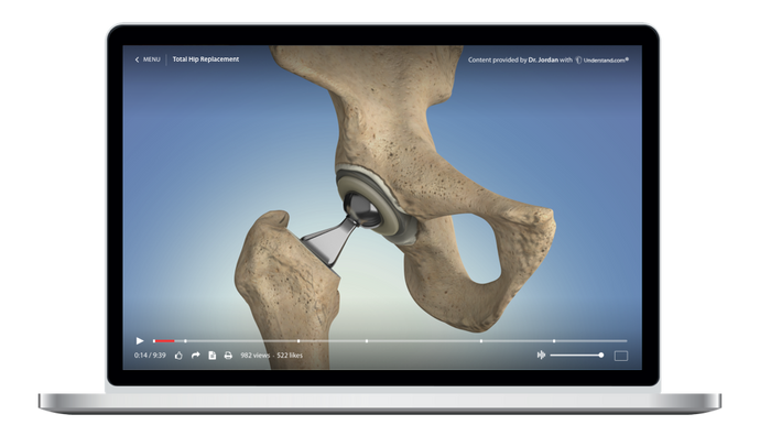 Total Hip Replacement Animation