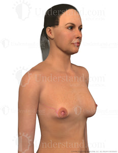 Nipple Sparing Mastectomy Image