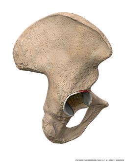 Hip Detached Labrum Lateral Image