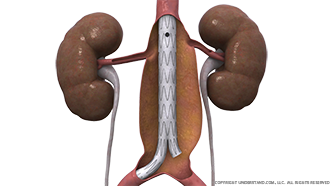 Aortic Aneurysm Graft Image