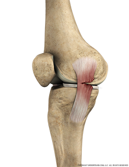 Torn MCL Medial Extended Image