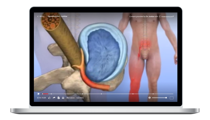 Herniated Disc - Lumbar Animation