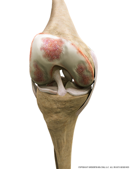 Knee Rheumatoid Arthritis Anterior Flexed Image