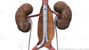 Aortic Aneurysm Graft Image