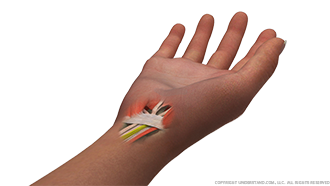 Carpal Tunnel Release Image