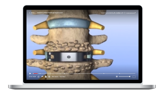 Lumbar - Anterior Lumbar Interbody Fusion (ALIF) Animation