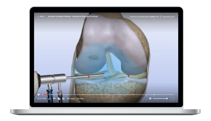 Articular Cartilage Problems - Removal of Damaged Cartilage Animation