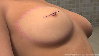 Nipple Reconstruction Image