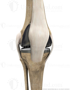 Total Knee Replacement with Ligaments Anterior Extended Image