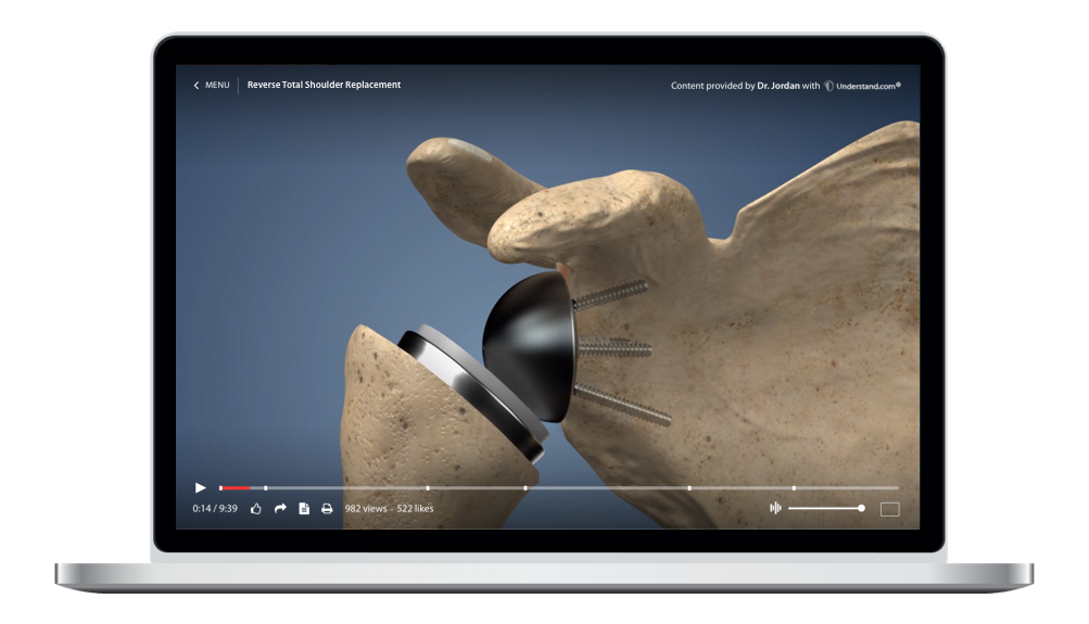 Reverse Total Shoulder Replacement Animation – Understand.com