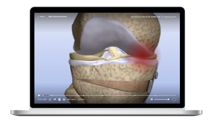 High Tibial Osteotomy Animation