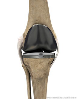 Total Knee Replacement Anterior Extended Image