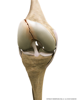 Femoral Fracture Anterior Flexed Image