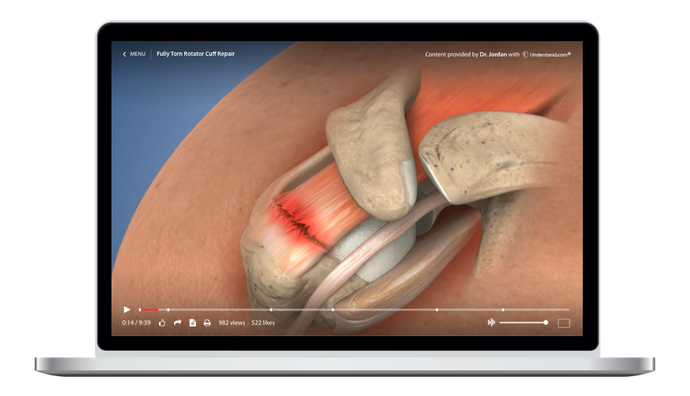 Fully Torn Rotator Cuff Repair Animation