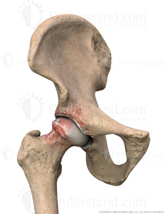 Hip Impingement Anterior Image