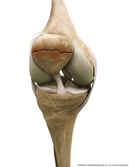 Patellar Fracture Anterior Flexed Image