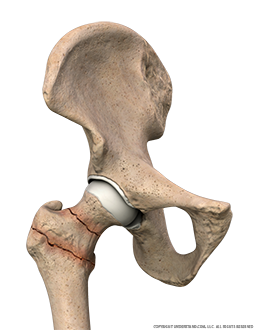 Hip Fractures Anterior Image