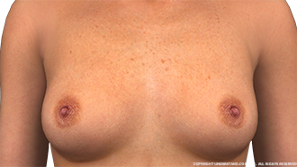 Breasts Female Anterior Image