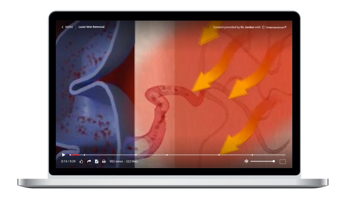 Laser Vein Removal Animation