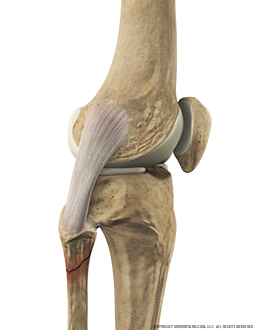 Fibular Fracture Lateral Extended Image