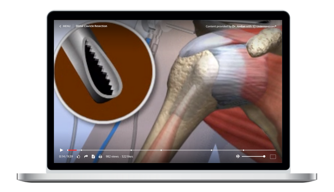 Distal Clavicle Resection Animation