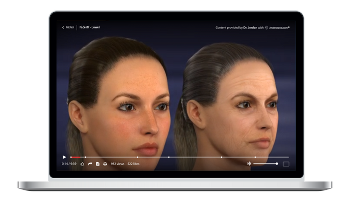 Facelift - Lower Animation