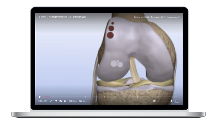 Cartilage Transplants - Autograft (from you) Animation
