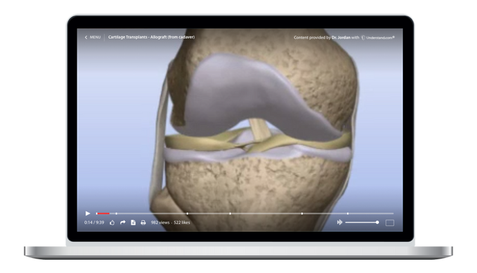Cartilage Transplants - Allograft (from cadaver) Animation