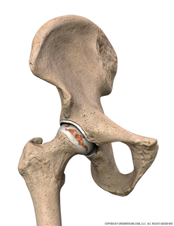 Hip Osteoarthritis Anterior Image