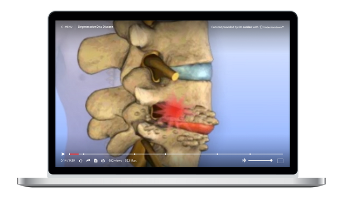 Degenerative Disc Disease Animation