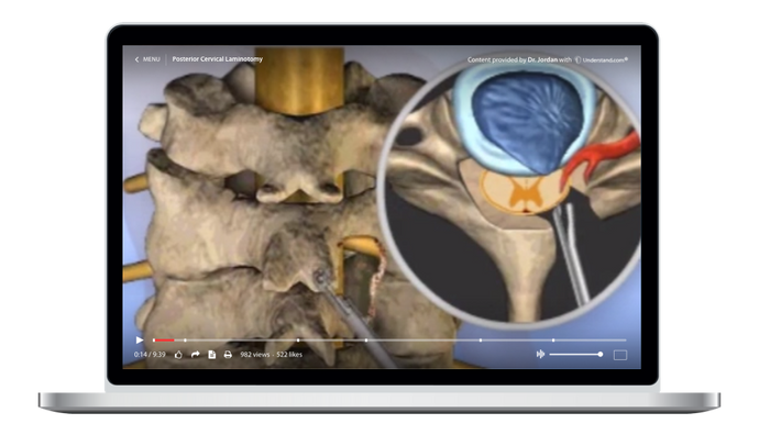 Cervical - Posterior Cervical Laminotomy Animation