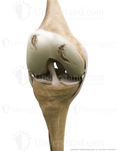 Knee Damaged Cartilage Anterior Flexed Image